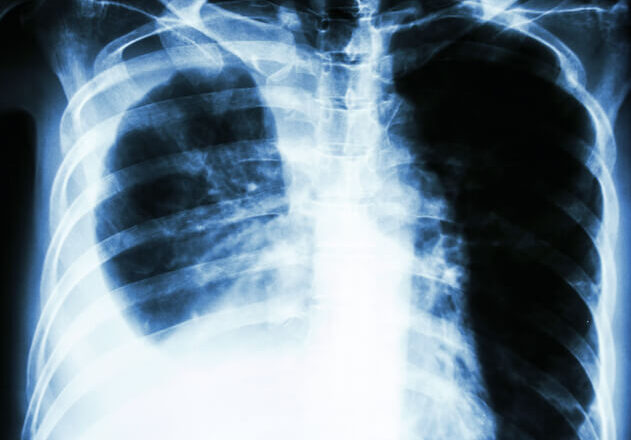 Why do insurers resist asbestos pleural thickening claims?